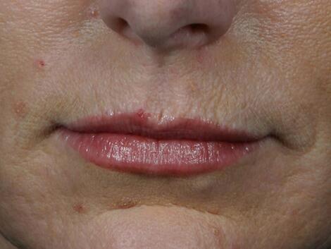 Wrinkle Reduction Before & After Image