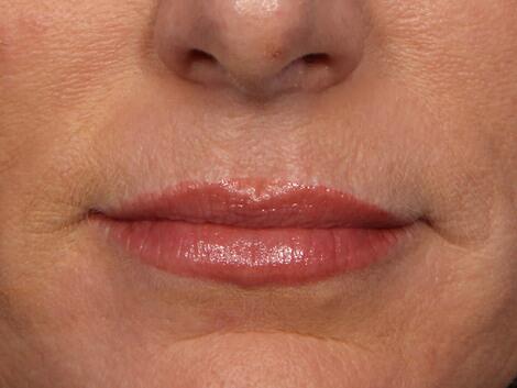 Wrinkle Reduction Before & After Image