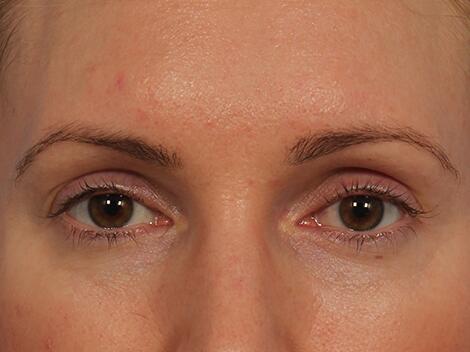 Wrinkle Reduction Before & After Image