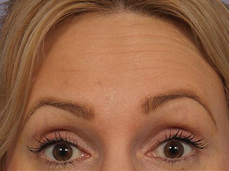 Wrinkle Reduction Before & After Image