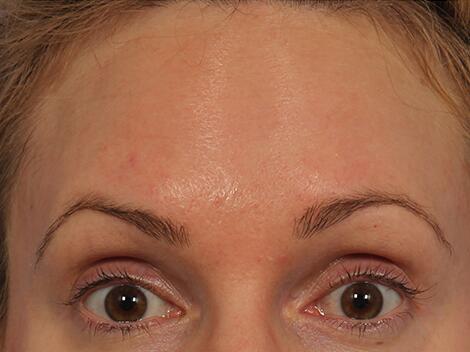 Wrinkle Reduction Before & After Image